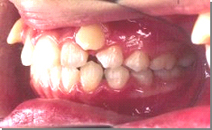 八重歯 施術前