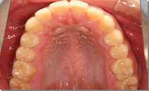 前歯のすき間、歯列の凸凹 施術後