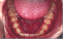 前歯のすき間、歯列の凸凹 施術前