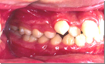 前歯のすき間、歯列の凸凹 施術前