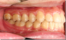 前歯のすき間、歯列の凸凹 施術後