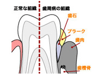 歯周治療